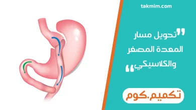 تحويل مسار المعدة المصغر والكلاسيكي