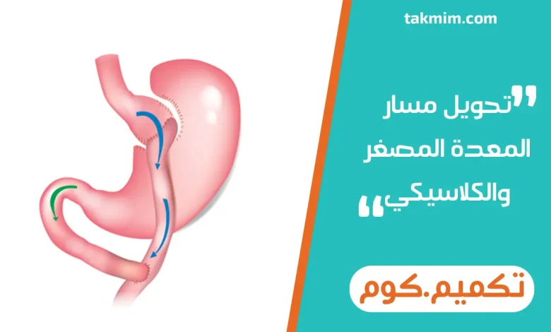 تحويل مسار المعدة المصغر والكلاسيكي