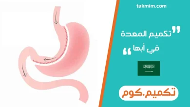 تكميم المعدة في أبها