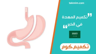 تكميم المعدة في الخبر