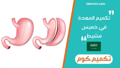تكميم المعدة في خميس مشيط