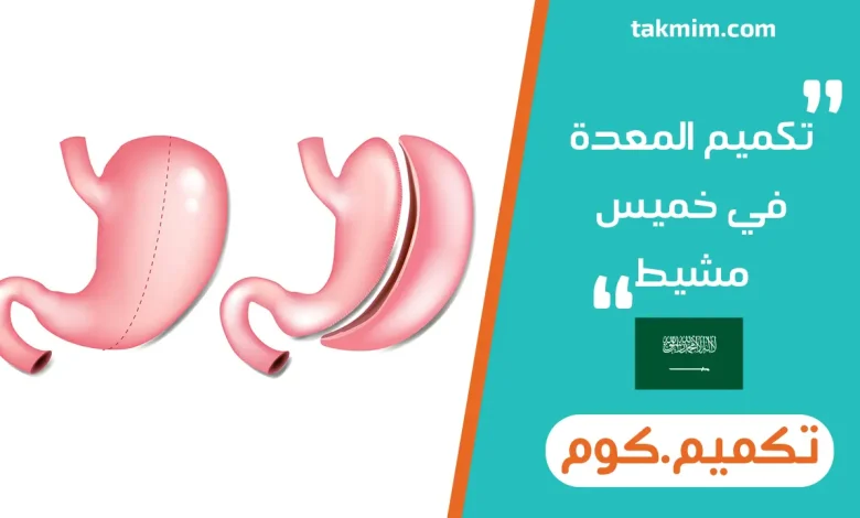 تكميم المعدة في خميس مشيط