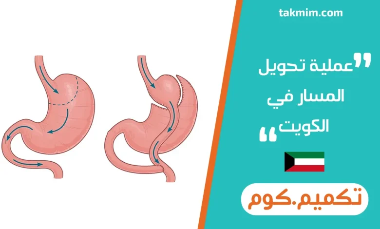عملية تحويل المسار في الكويت